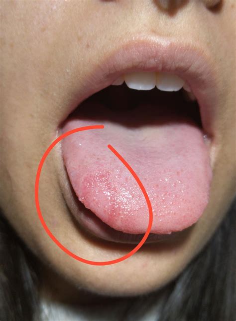 Red patch on tongue : Dentistry