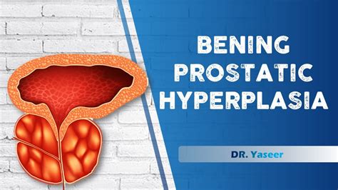 Benign Prostatic Hyperplasia Dr Yaser Lecture Youtube