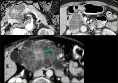 The Radiology Assistant Pancreas Cystic Lesions