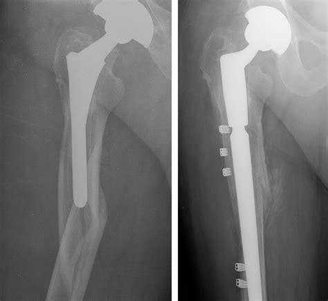 Periprosthetic Fracture After Total Hip Replacement Dr Mukhi’s Raj Hospital
