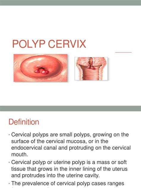 Polyp Cervix Pdf Vagina Uterus