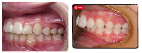 Can Overjet Be Corrected With Invisalign Millerrlangland
