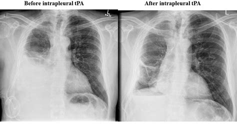 Learn about different types of pleural effusions, including symptoms, causes, and treatments. Complications of indwelling pleural catheter use and their ...