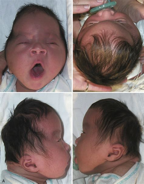 Congenital Anomalies Of The Skull Clinical Gate