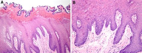 Chronic Frictionalfactitial Keratosis A Parakeratosis With Fissures