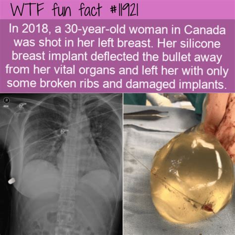 Wtf Fun Fact Breast Implant Deflects Bullet