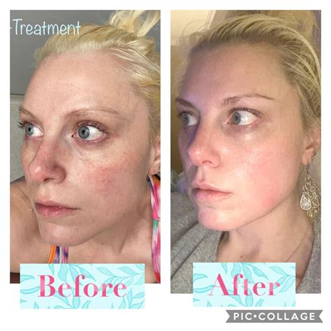 Before And After Laser Micro Peel Newtox Forehead Pulse Dye Laser