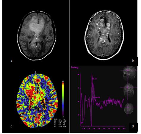 Modern Neuroimaging Techniques In The Diagnosis Of Brain Tumours