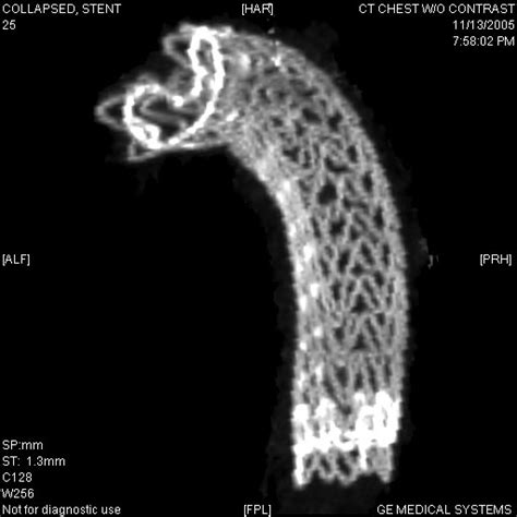 Scvs Complications Associated With Thoracic Stent Graft Repair Of