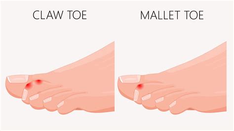 10 Common Foot Problems And How To Manage Them Everyday Health