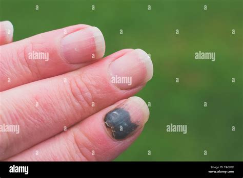 Hematoma Hi Res Stock Photography And Images Alamy