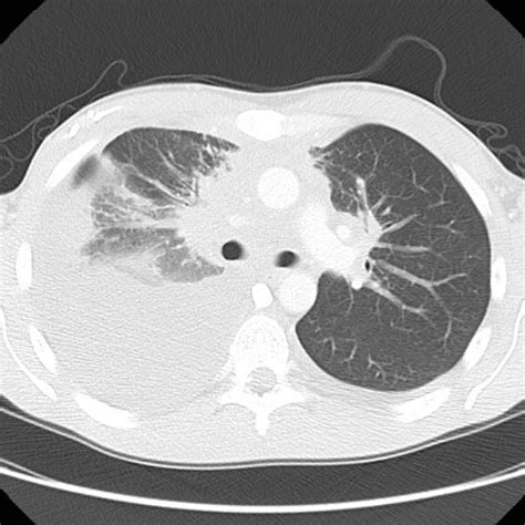 Non Hodgkin Lymphoma Involving Lung Radiology Case