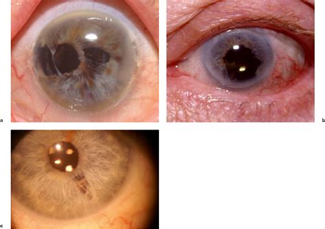 Iris Defects And Complications Ento Key