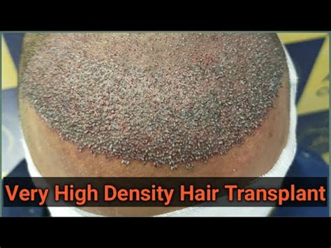 Live Hair Transplant Surgery From OT Hair Transplant Patient