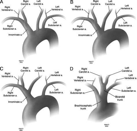 Vascular Mind ANATOMICAL VARIANTS OF AORTIC ARCH BRANCHES VARIANTES
