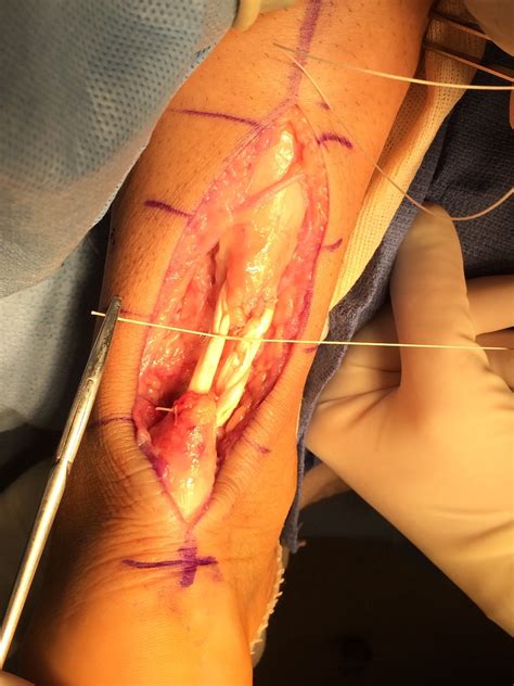 A tendon (or sinew) is a tough cord or band of dense white fibrous connective tissue that unites a muscle with some other part (often a bone) and transmits the force which the muscle exerts. Employing Free Semitendinosus Allograft For Repair Of A ...