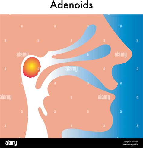 Adenoids Hi Res Stock Photography And Images Alamy
