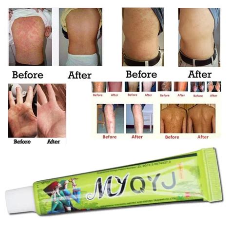 15gbox Hot Sell Skin Psoriasis Cream Dermatitis Eczematoid Eczema