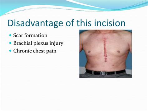 Ppt Incisions In Cardiothoracic Surgery Powerpoint Presentation Free