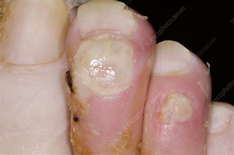 Toe Infection In A Diabetic Stock Image C0168161 Science Photo