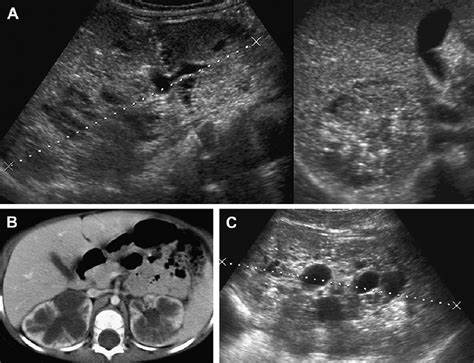 Поликистоза почек диета