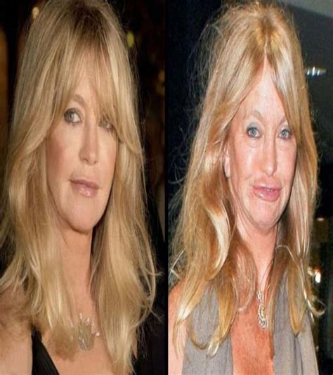 Of The Worst Celebrity Plastic Surgery Disasters Viralcola