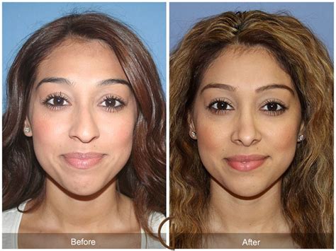 Rhinoplasty Nose Surgery Granite Hills Ca Before After Photo 47