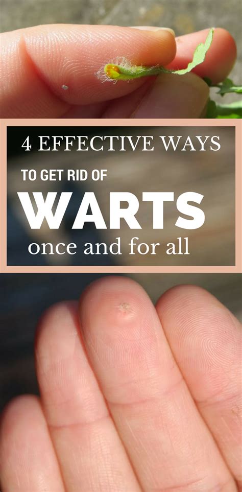 4 Effective Ways To Get Rid Of Warts Once And For All Get Rid Of