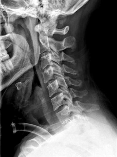 Cervical Spine Pathology Radiology U Of U School Of Medicine