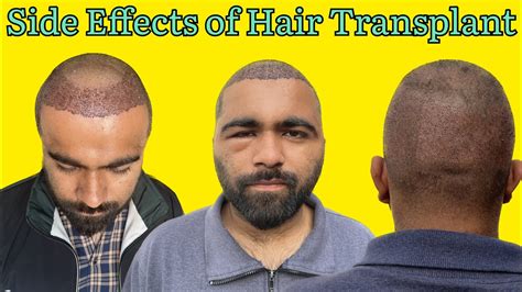 Side Effects Of Hair Transplant Precautions After Hair Transplant