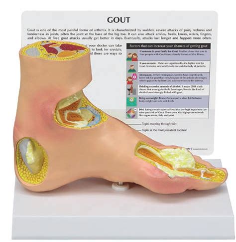 Gout Foot Model Clinical Charts And Supplies