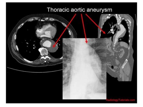 Presentation1 Radiological Imaging Of Thoracic Aortic Aneurysm