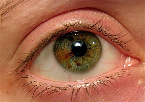 Частичная гетерохромия глаз у людей что это такое 90 фото