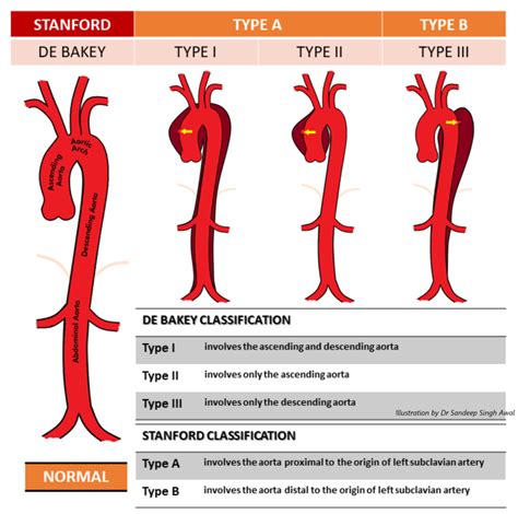 Stanford And Debakey Classifications Of Aortic Dissection Download