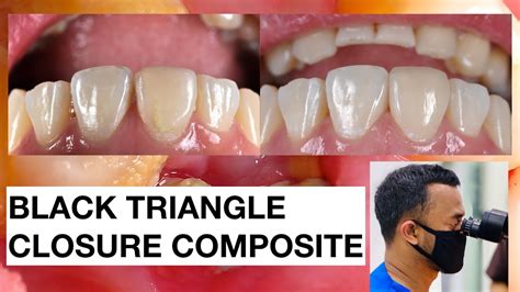 Black Triangle Closure Class Iv Composite Normal Speed Dokter