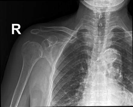 Avulsion Fracture Greater Tuberosity Of Humerus Radiology Case