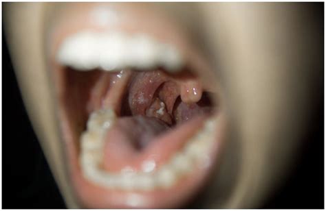 Cryptic Tonsils Symptoms Causes Treatment Removal Prevention