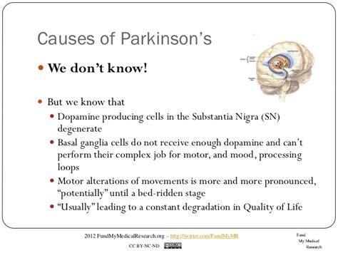 Parkinson disease (pd) is a common neurodegenerative condition. Quantifying Parkinson's Disease with a Wii
