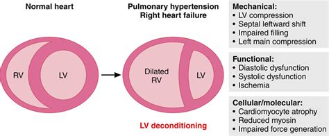 Systemic Consequences Of Pulmonary Hypertension And Right Sided Heart