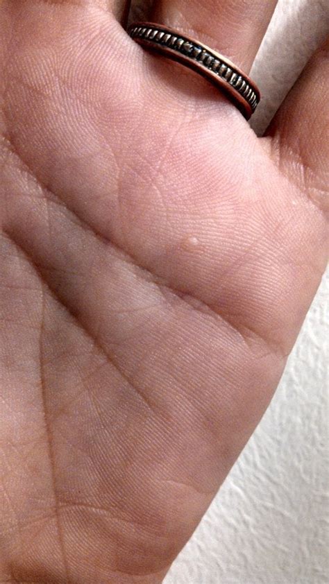 I Have Had This Tiny Bump On My Left Hand Since I Was 8 Years Old Any