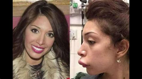 Celebrity Before And After Plastic Surgery Disasters Youtube