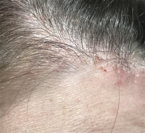 Is This Dry Scalp Psoriasis Or Something Else This Is A Photo Of The
