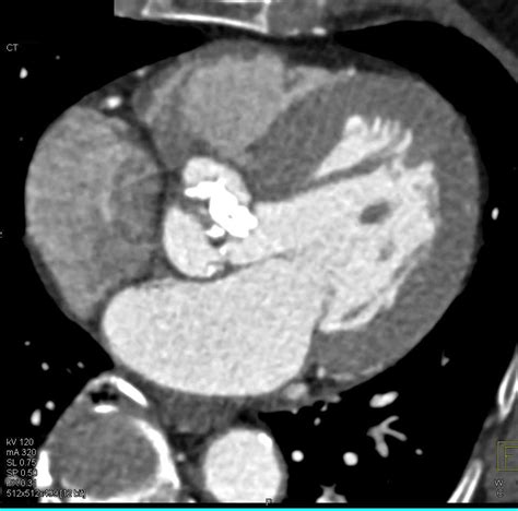 Bicuspid Valve With Extensive Calcification And Aortic Stenosis