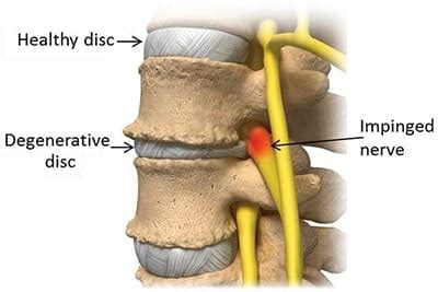 What Is Degenerative Disc Disease Spine Orthopedic Center