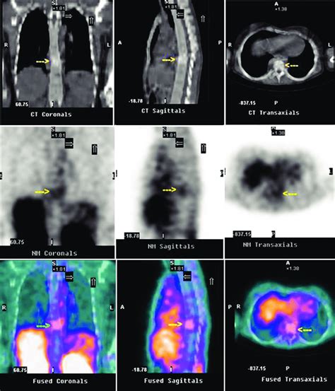 Technetium 99m Ethambutol Scintigraphy Diagnostic Image Of 27 Year Old