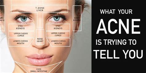 Acne Body Mapping Zones Face Mapping Face Mapping Acne Acne Mapping Images