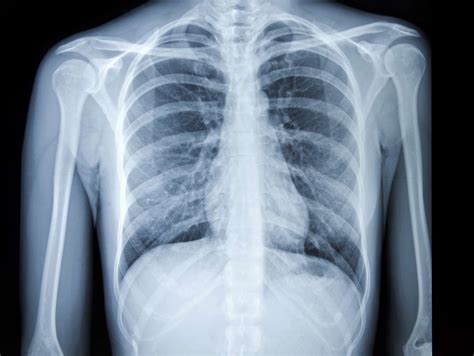 Verwendung Von Röntgenthorax Bei Der Diagnose Von Lungenkrebs Medde