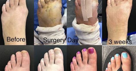 Cosmetic Foot Surgeon Near Me Jerilyn Welker