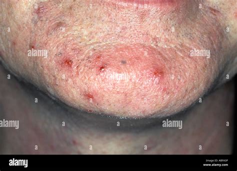 Acne Lesions On The Chin Inflammatory Pustules Stock Photo Alamy