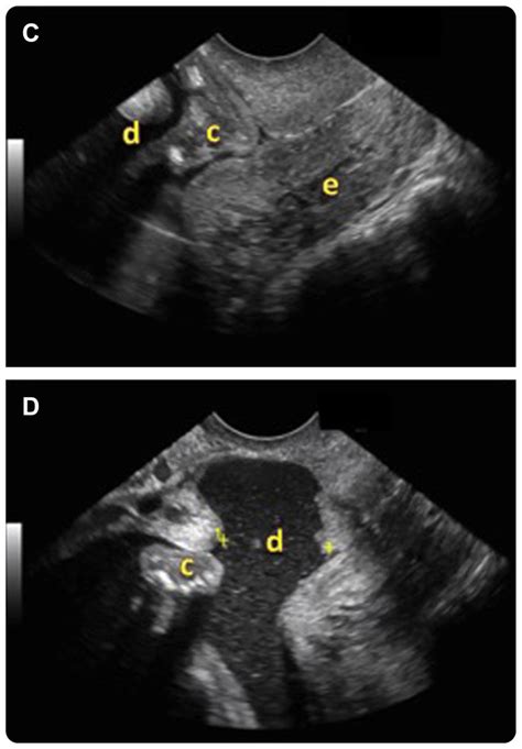 Ultrasound Images A Dichorionic Diamniotic Twin Pregnancy With